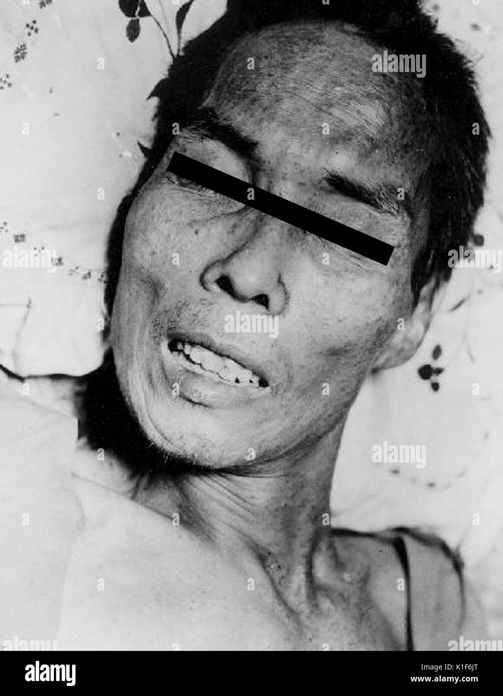 Face of man with tetanus. Tetanus in a 46-year-old man, Manila. Muscular spasms, abdomen and limbs, from tetanus due to shell fragments wound on hand. Image courtesy CDC/AFIP/C. Farmer, 1965. Stock Photo