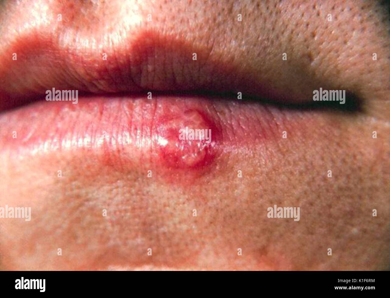 This is a close-up of the lip of patient (PHIL 5434) with a herpes simplex lesion on the lower lip due to the (HSV1) pathogen. Herpes simplex virus type1 usually is the cause for oral lesions sometimes referred to as ?cold sores?, ?fever blisters? or more technically known as ?recurrent herpes labialis?. Image courtesy CDC/Dr. Herrmann, 1964. Stock Photo