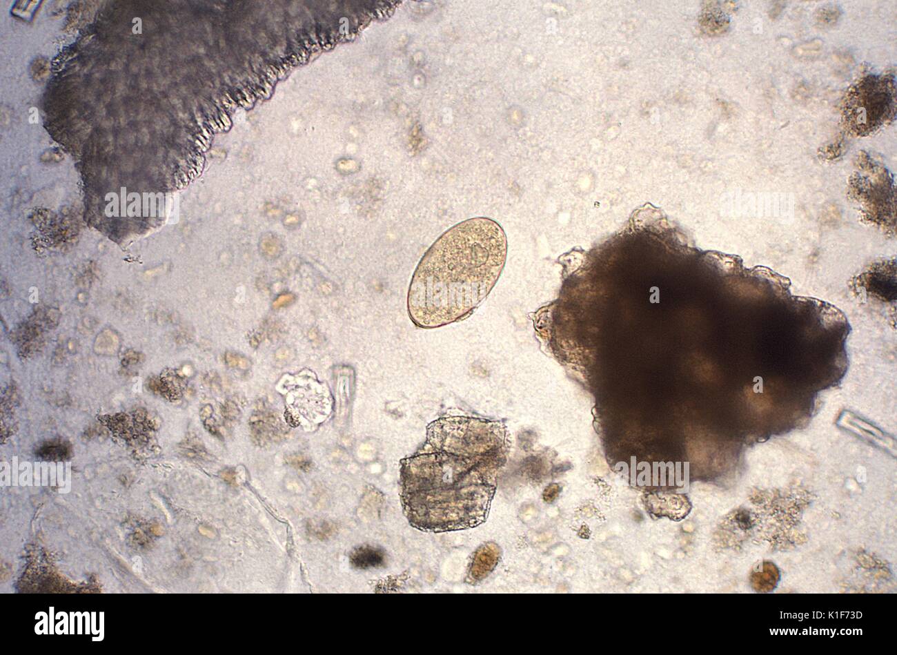 Magnified 128X, this photomicrograph revealed the presence of a trematode, Fasciola hepatica, or ?sheep liver fluke?, egg, which is described as broadly ellipsoidal, operculated, and measure 130{micro}m to 150{micro}m long by 60{micro}m to 90{micro}m wide. The eggs are unembryonated when passed in feces. The eggs of F. hepatica can be difficult to distinguish from Fasciolopsis spp. although the abopercular end of the former often has a roughened or irregular area. <b><u>Clinical Features:</u></b>. Image courtesy CDC/Dr. Mae Melvin, 1979. Stock Photo