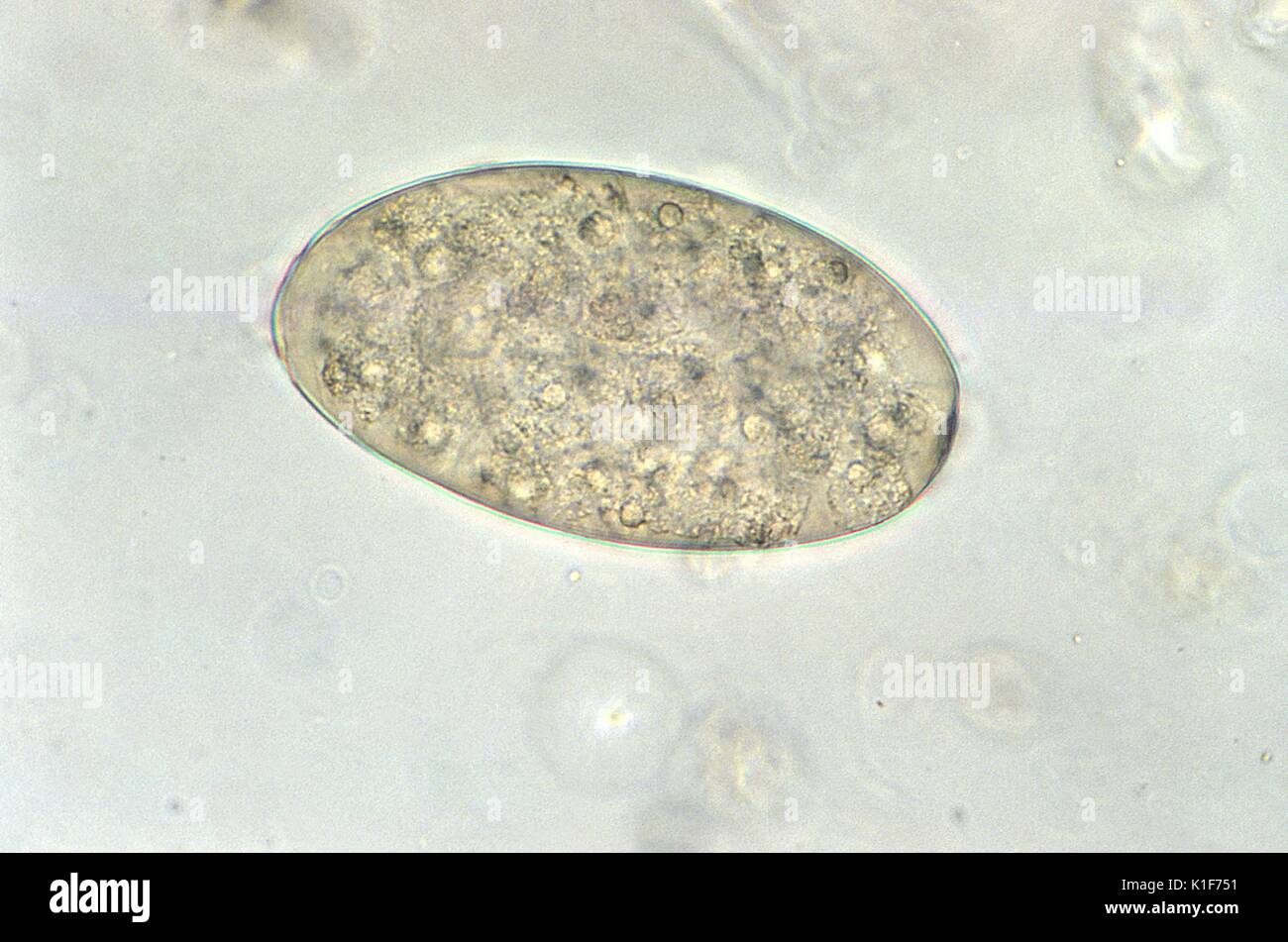 Under a high magnification of 400X, this photomicrograph revealed some of the ultrastructural morphology exhibited by a trematode, Fasciolopsis buski, egg, which is described as broadly ellipsoidal, operculated and measuring 130{micro}m to 150{micro}m long, by 60 {micro}m to 90{micro}m wide. These eggs are unembryonated when passed in feces. The eggs of F. buski can be difficult to distinguish from Fasciola hepatica, although the abopercular end of the latter often has a roughened or irregular area. <b><u>Clinical Features:</u></b>. Image courtesy CDC/Dr. Mae Melvin, 1979. Stock Photo