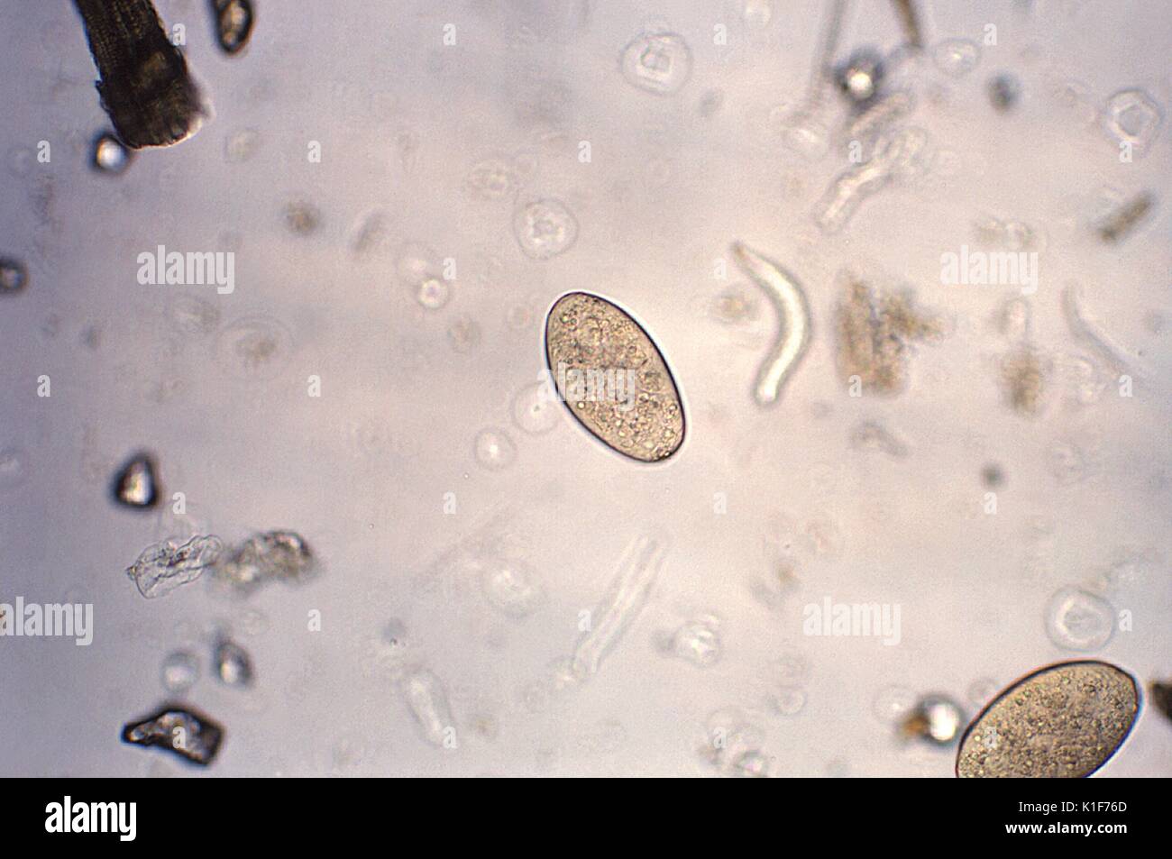 Magnified 128X this photomicrograph revealed the presence of two trematode, Fasciolopsis buski, eggs, which are described as broadly ellipsoidal, operculated and measuring 130{micro}m to 150{micro}m long, by 60 {micro}m to 90{micro}m wide. The eggs are unembryonated when passed in feces. The eggs of F. buski can be difficult to distinguish from Fasciola hepatica, although the abopercular end of the latter often has a roughened or irregular area. <b><u>Clinical Features:</u></b>. Image courtesy CDC/Dr. Mae Melvin, 1979. Stock Photo