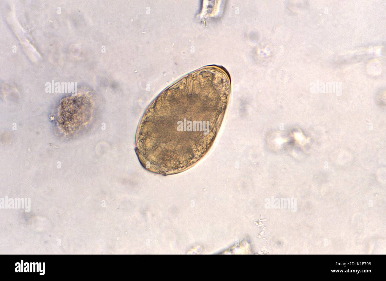 Magnified 400X, this photomicrograph revealed some of the ultrastructural morphology of a single trematode Paragonimus westermani egg. P. westermani eggs range from 80{micro}m to 120{micro}m long by 45{micro}m to 70{micro}m wide. They are yellow-brown, ovoid or elongate, with a thick shell, and often asymmetrical with one end slightly flattened. At the large end, the operculum is clearly visible. The opposite (abopercular) end is thickened. The eggs are unembryonated when passed in sputum or feces. See PHIL 10855 for another view of this egg. <b><u>Clinical Features:</u></b>. Image courtesy CD Stock Photo