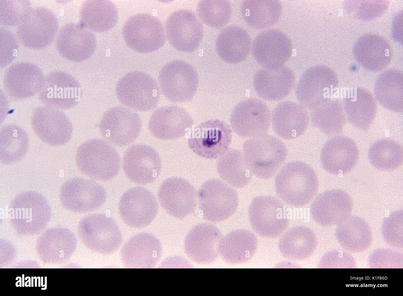 Magnified 1125X, this thn-film, Giemsa-stained photomicrograph revealed the presence of a growing Plasmodium ovale trophozoite, with a ?ring? nucleus. Plasmodium ovale rings have sturdy cytoplasm and large chromatin dots. Red blood cells (RBCs) are normal to slightly enlarged (1 1/4 *), may be round to oval, and are sometimes fimbriated. Schuffner's dots are visible under optimal conditions. Image courtesy CDC/Dr. Mae Melvin, 1973. Stock Photo