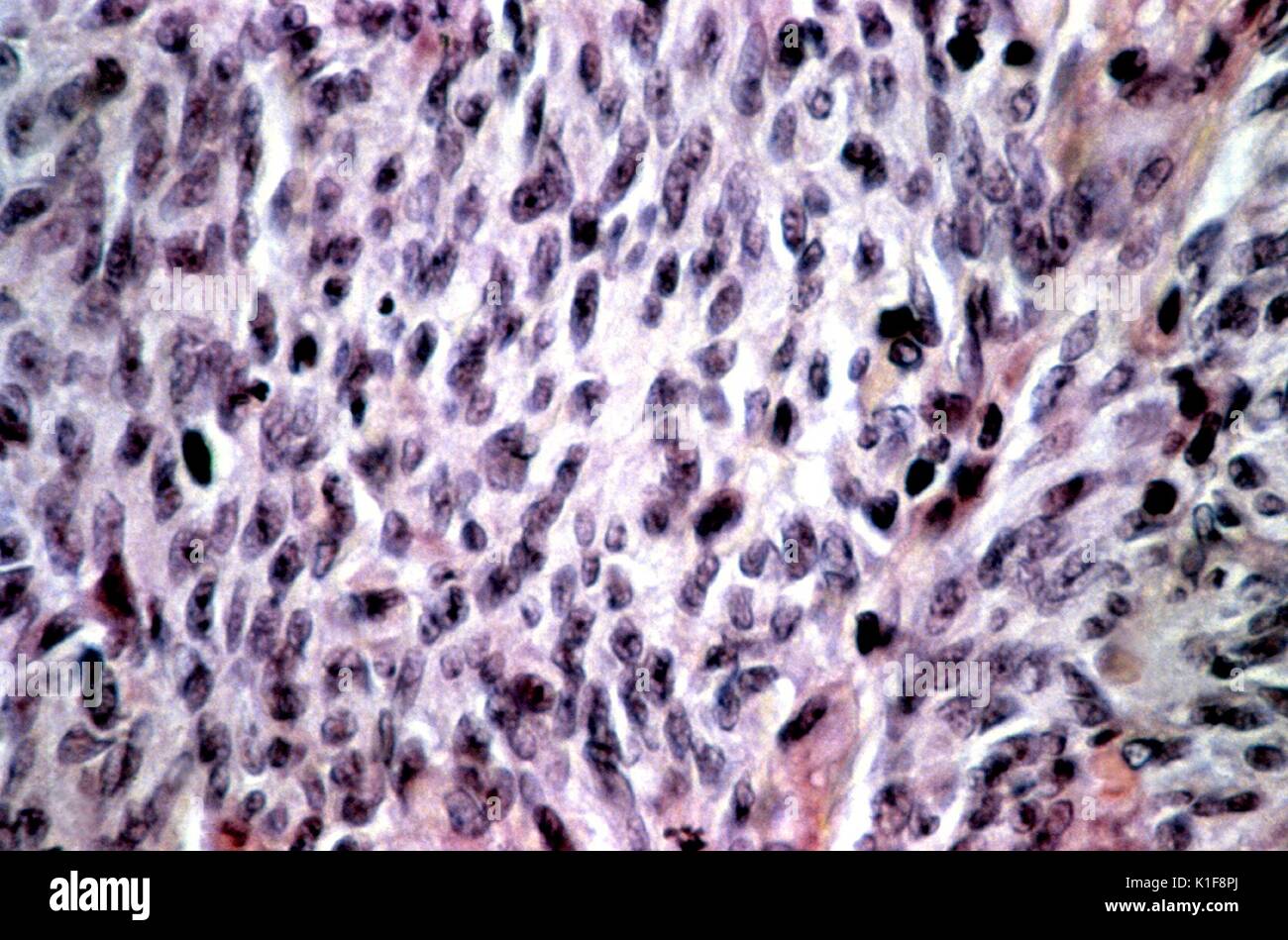 This highly magnified micrograph depicts the usual histopathologic changes found in a Kaposi?s sarcoma lesion. Called pleomorphism, note how the nuclei vary in size and staining qualities, with some of the nuclei being atypical. Kaposi?s sarcoma (KS) is a cancer that is common in those who?ve developed the human immunodeficiency virus (HIV), or an AIDS infection. Image courtesy CDC/Dr. Steve Kraus, 1981. Stock Photo