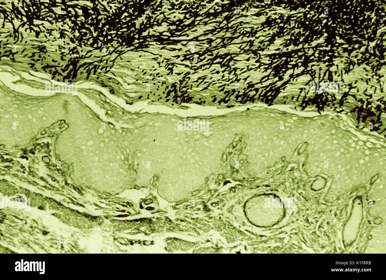 Histopathology of Candida esophagitis. Methenamine silver stain (digitally colorized). Histopathology of esophageal candidiasis in a rhesus monkey. Image courtesy CDC. 1974. Stock Photo