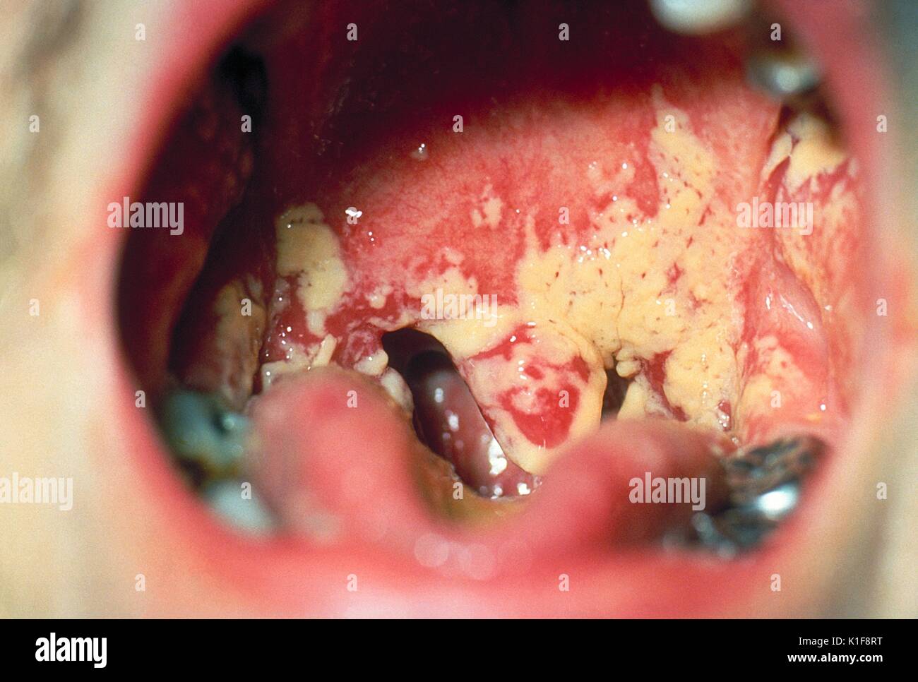 Oral thrush. Aphthae. Candida albicans . Image courtesy CDC. 1990. Stock Photo