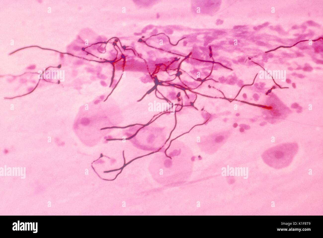 This Gram-stained micrograph from a patient with pulmonary candidiasis  reveals the presence of the fungus C. albicans . Candida albicans lives in  or on numerous parts of the body as normal flora.