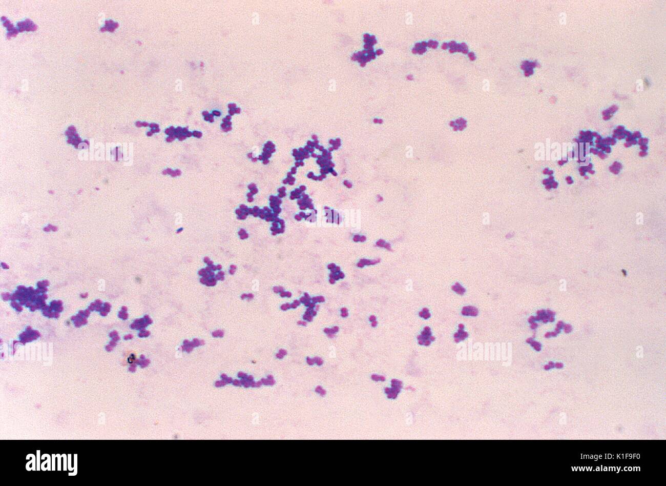 Staphylococcus aureus light microscopy. Morphology of Staphylococcus aureus  under the microscope. Micrograph of S.aureus, Gram stain. Gram-stained  smear from culture.