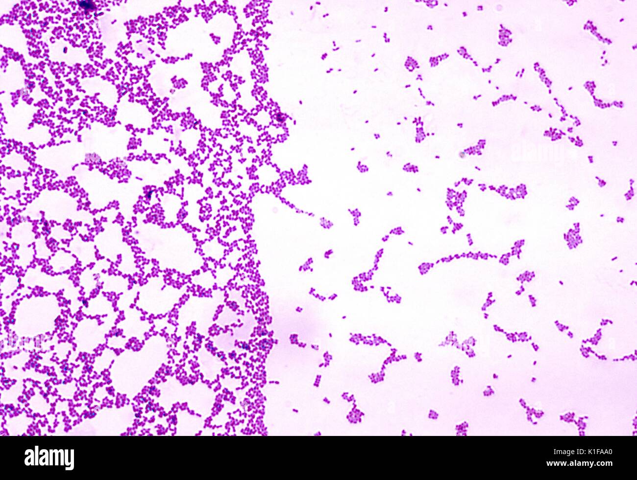 A photomicrograph of Streptococcus mutans bacteria using Gram stain technique, Blood agar plate culture yields coccal-like morphology without chains The S mutans organism can cause subacute bacterial endocarditis and dental caries Streptococci Image courtesy CDC/Dr Richard Facklam, 1975. Stock Photo