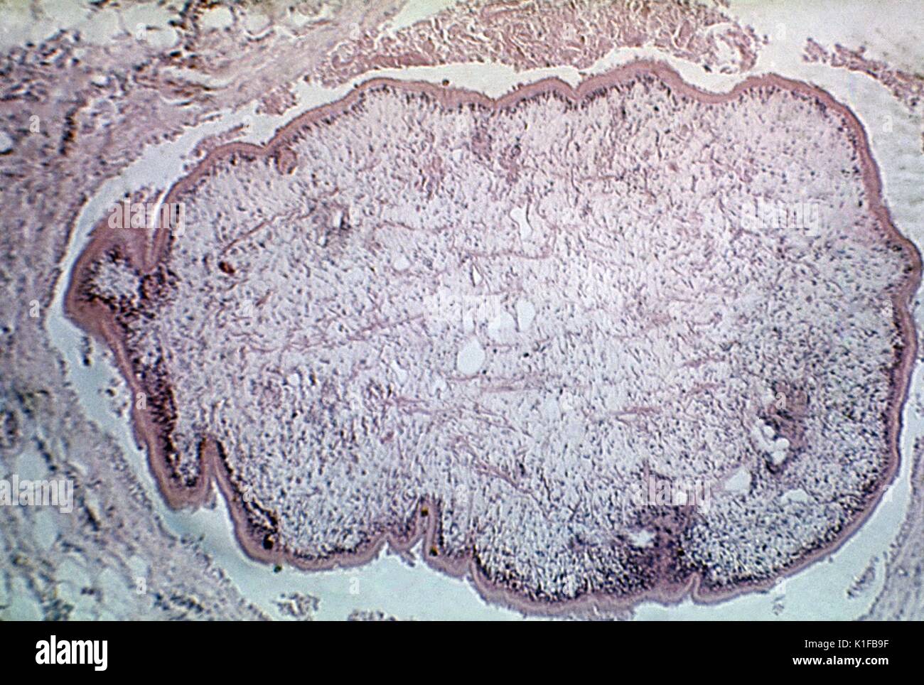 Histopathology of Sparganum proliferum infection. Parasite. Image courtesy CDC, 1962. Stock Photo