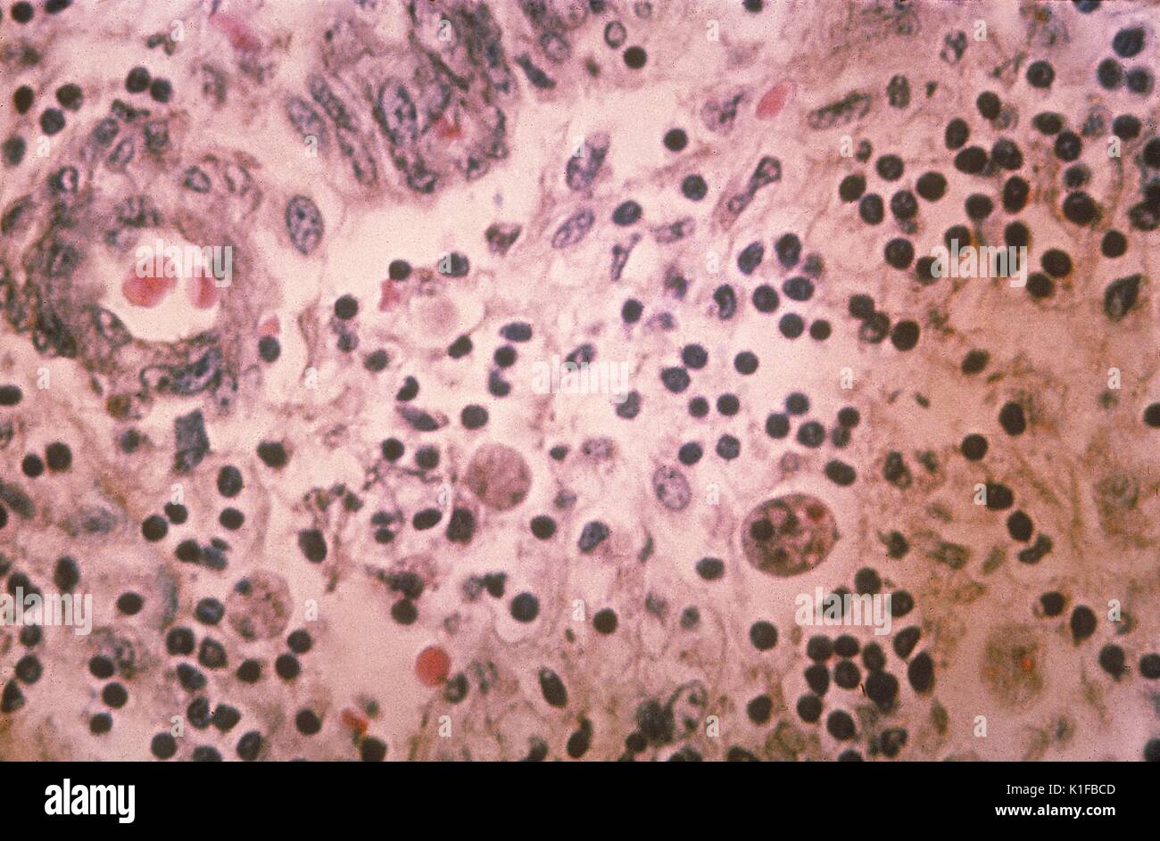 Histopathology of amebiasis. Parasite, ameba. Image courtesy CDC, 1962. Stock Photo