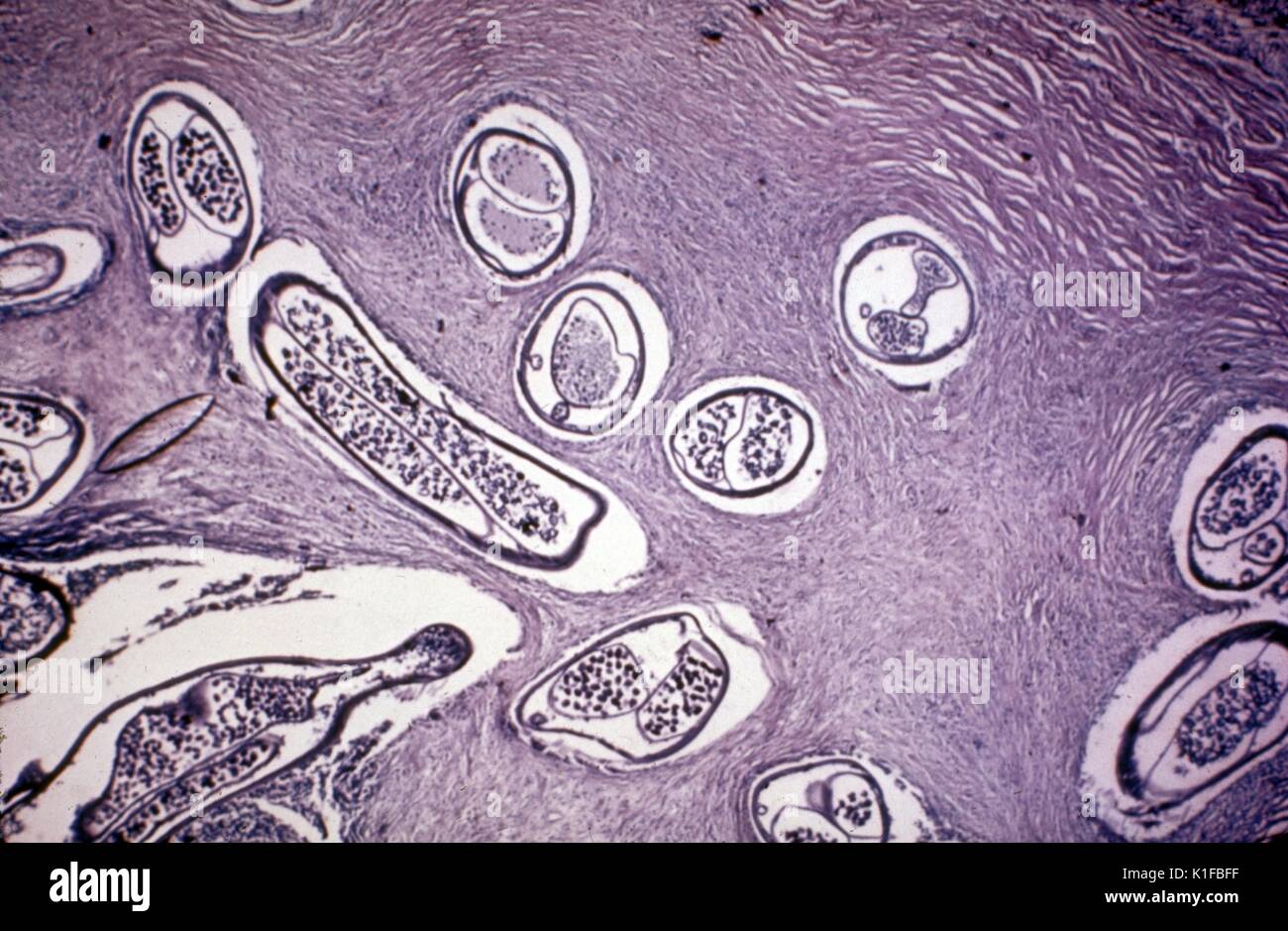 Histopathology of Onchocerca volvulus nodule. Onchocerciasis. Parasite. Image courtesy CDC/Dr. Mae Melvin. 1981. Stock Photo