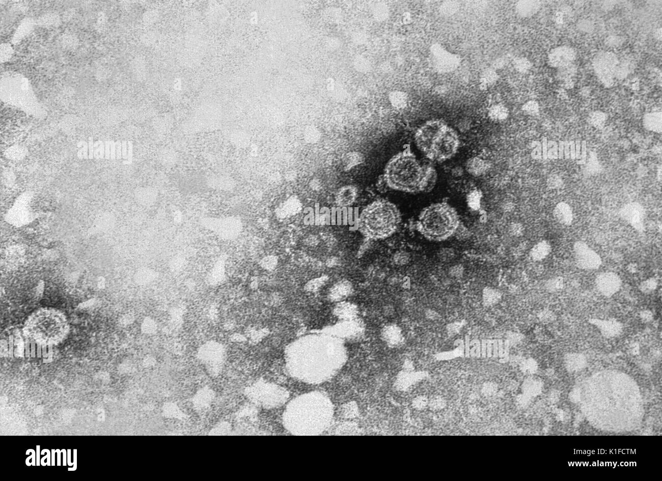 This transmission electron micrograph (TEM) revealed the presence of hepatitis B virions. The large round virions are known as Dane particles. See PHIL 10755, for a colorized version of this image. Hepatitis means inflammation of the liver. Toxins, certain drugs, some diseases, heavy alcohol use, and bacterial and viral infections can all cause hepatitis. Hepatitis is also the name of a family of viral infections that affect the liver, the most common types in the United States are hepatitis A, hepatitis B, and hepatitis C. Image courtesy CDC/Dr. Erskine Palmer, 1981. Stock Photo