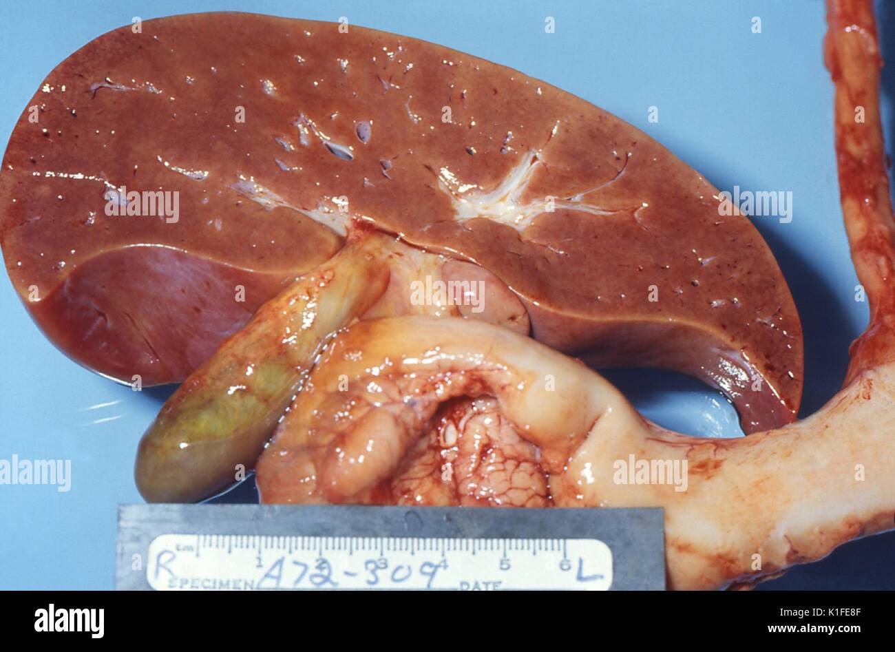 Gross pathology of liver in fatal Reye's syndrome, The cut surface of this gross autopsy specimen of a liver from a child who died of Reye's syndrome, displays a slight pallor, which was due to fat accumulation in the liver cells, also know as histiocytes. Image courtesy CDC/Dr. Edwin P. Ewing, Jr., 1972. Stock Photo