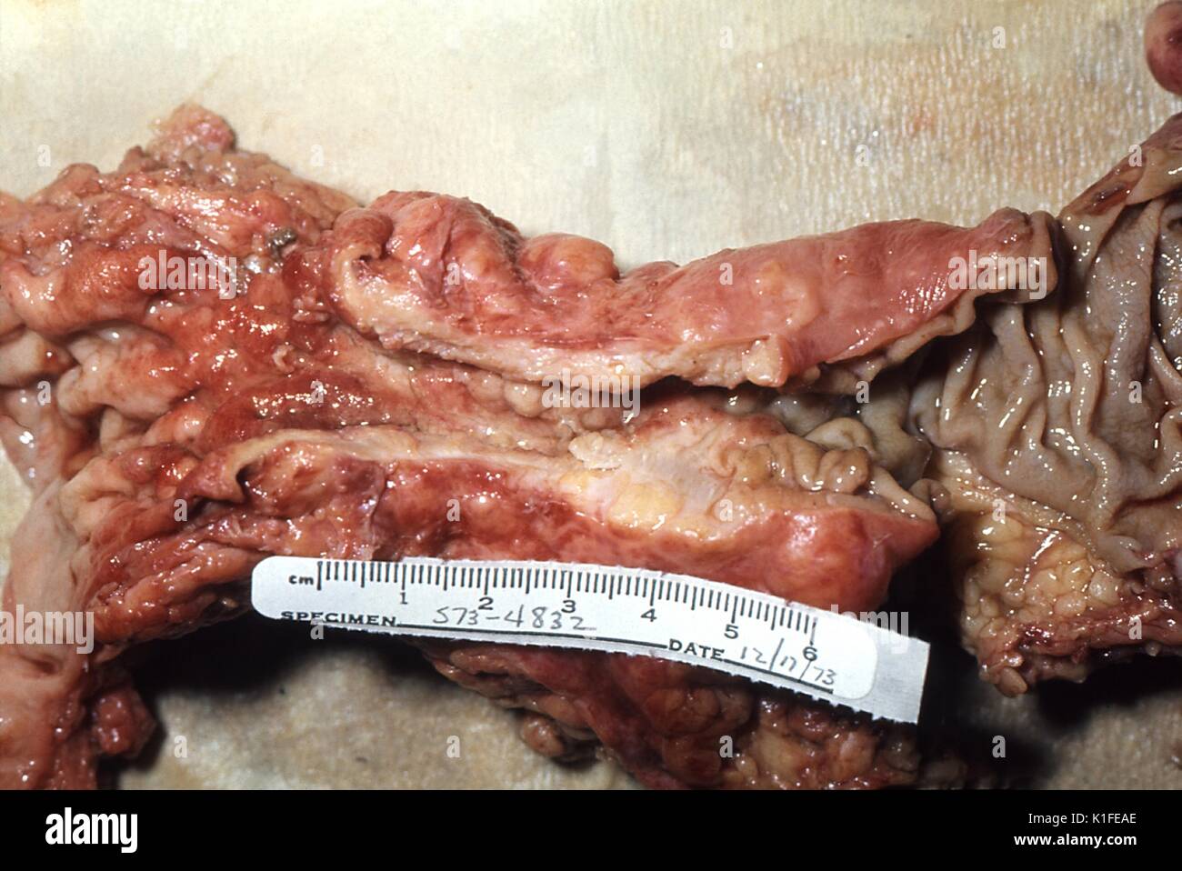 gross pathology of adenocarcinoma colon napkin ring configuration K1FEAE