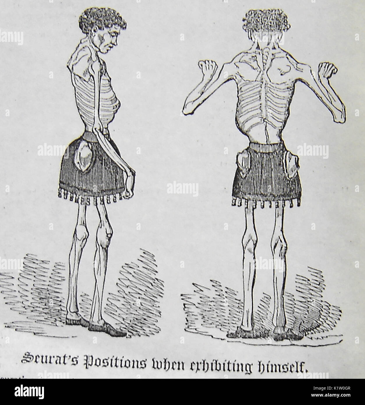 Real Victorian freak show exhibit Claude Seurat, billed as the human skeleton. He was said to suffer from a five metre long tapeworm Stock Photo