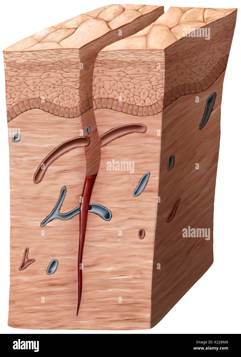 When an injury reaches down to the dermis, the capillaries within it burst, causing hemorrhaging. A blood clot forms at the bottom of the wound. Stock Photo