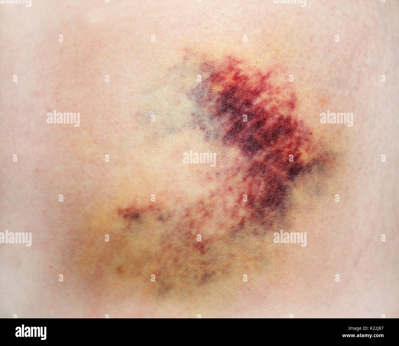 Bruise on white skin. Close-up photo Stock Photo