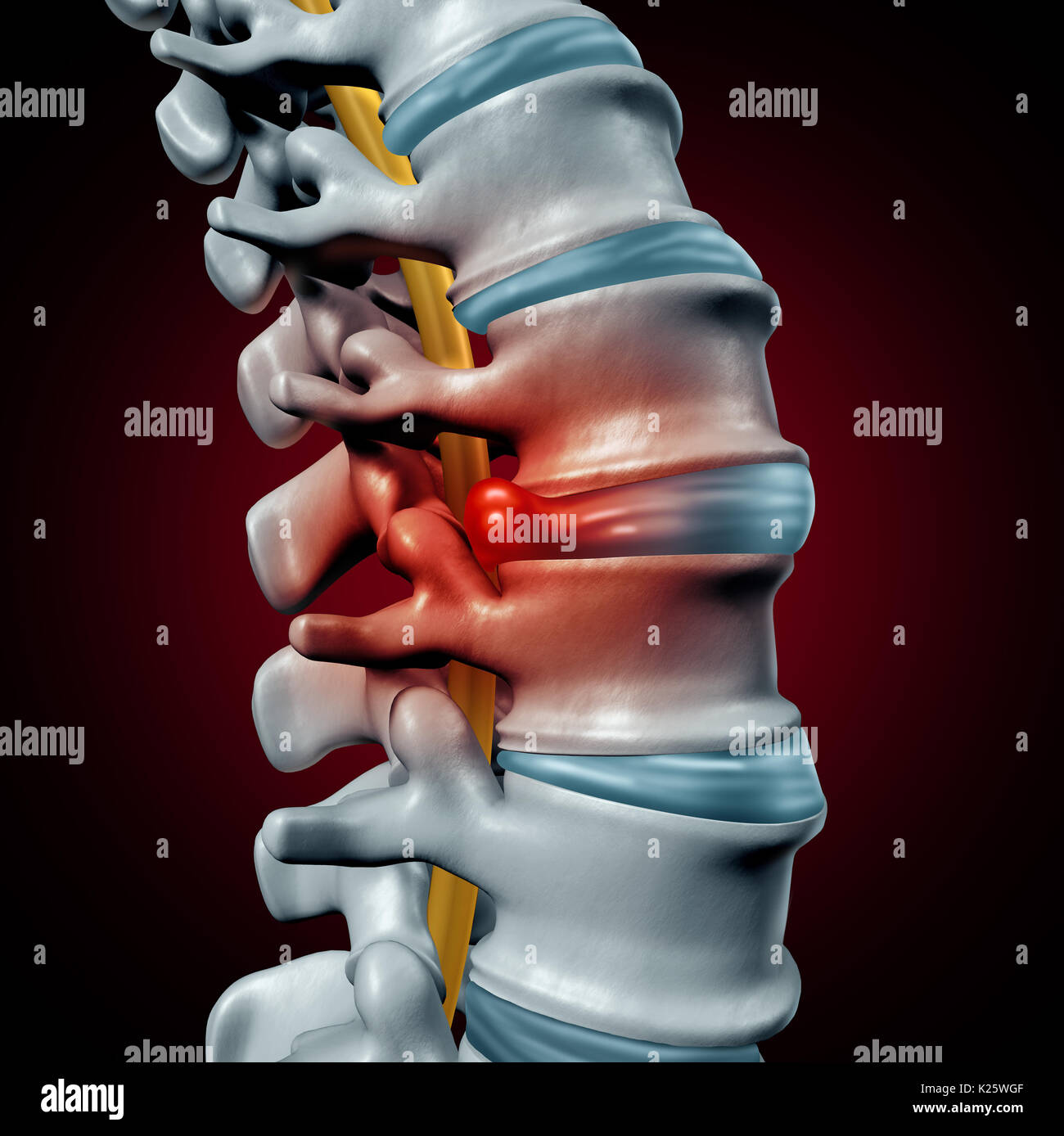 Human herniated disk concept and spine pain diagnostic as a human spinal system symbol as medical health problem and anatomy symbol. Stock Photo