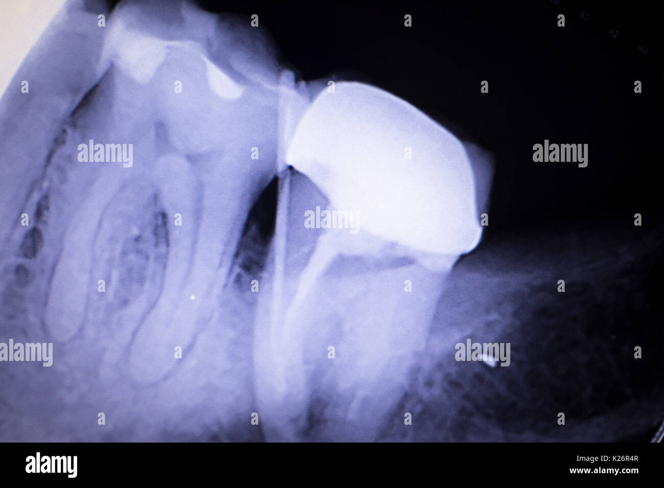 Dental xray test scan of tooth with crown filling and root canal