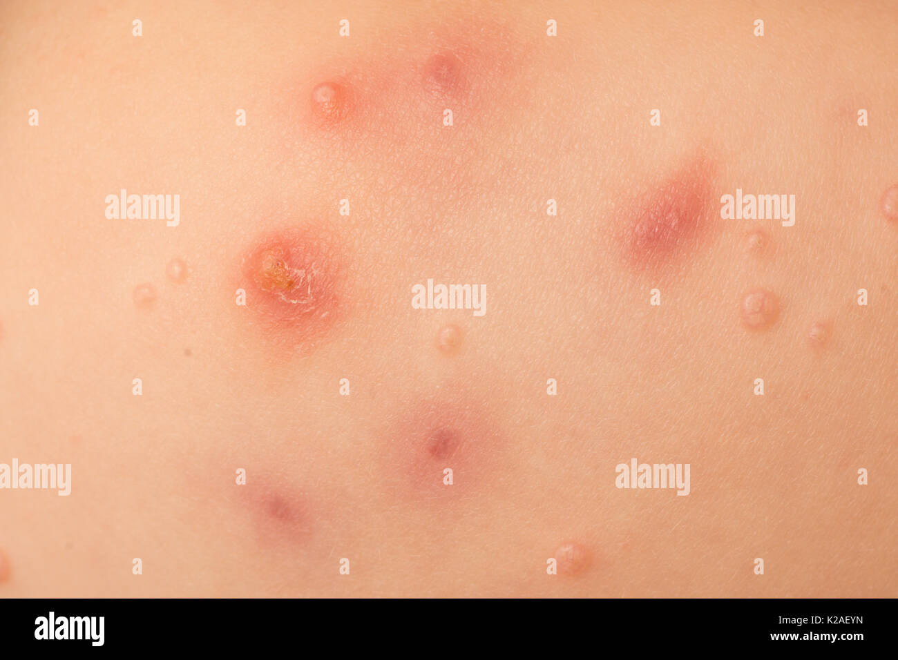 water warts, Molluscum contagiosum, virus, on bottom of a fout year old girl. Stock Photo