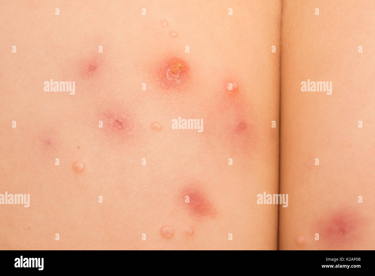 water warts, Molluscum contagiosum, virus, on bottom of a fout year old girl. Stock Photo