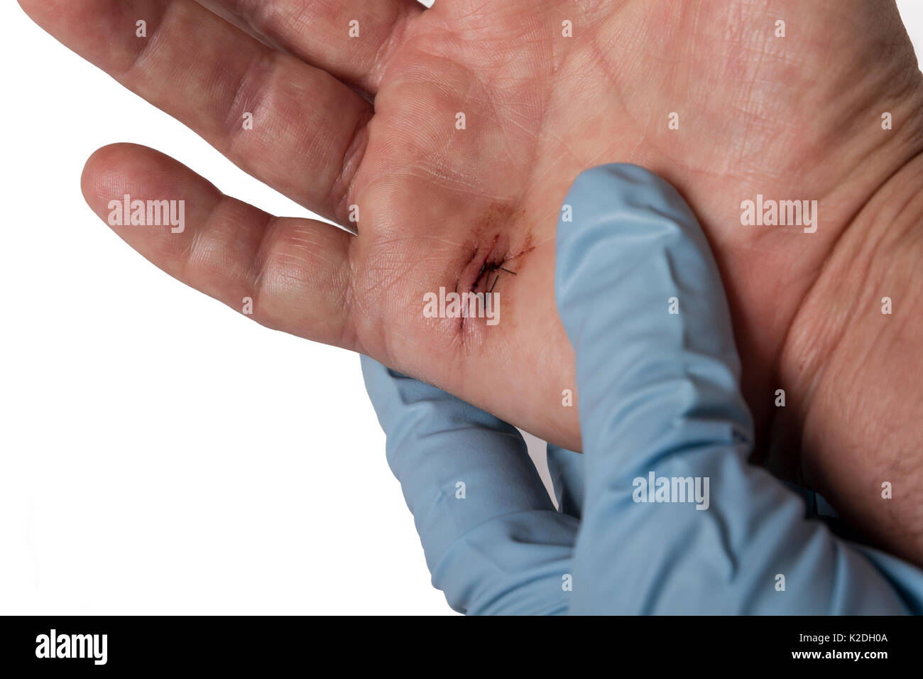 A hand with stitches Stock Photo