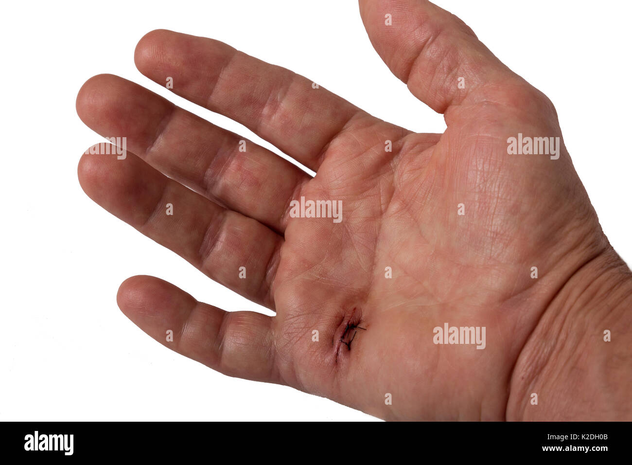 A hand with stitches Stock Photo