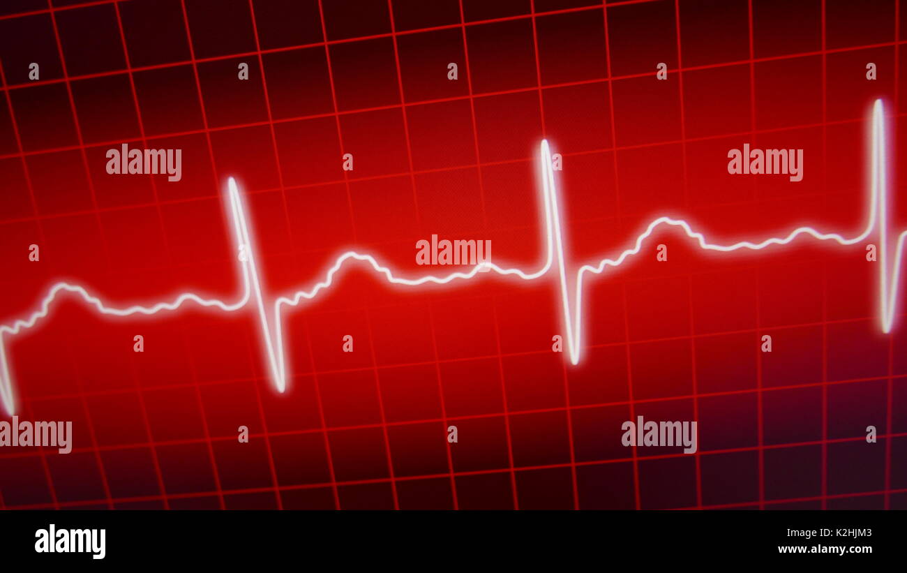 What Does A Heart Attack Look Like On An EKG? CardiacDirect