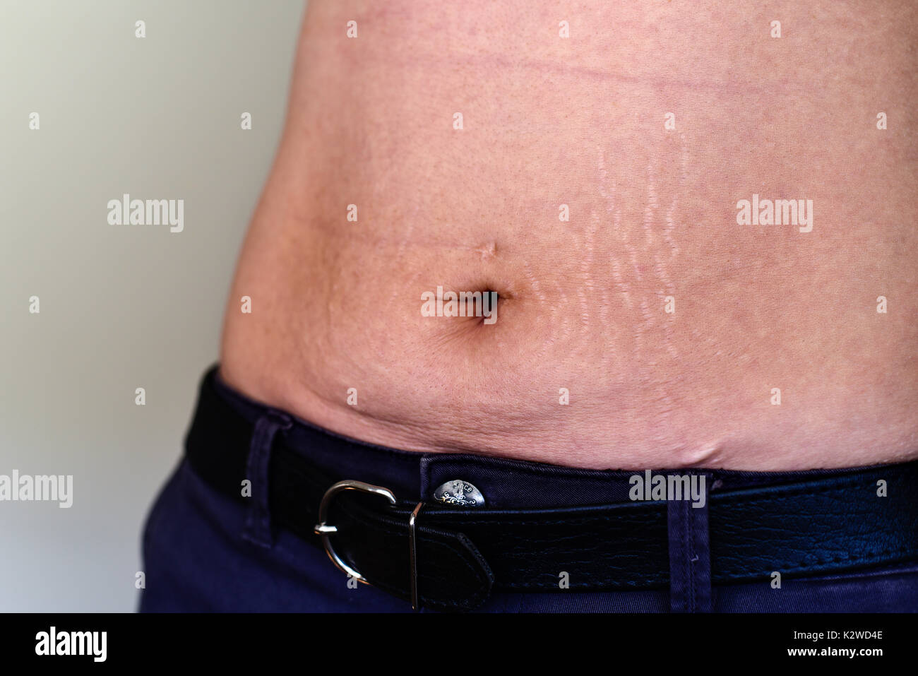Woman belly with stretch marks and scars after pregnancy,weight loss and piercing Stock Photo