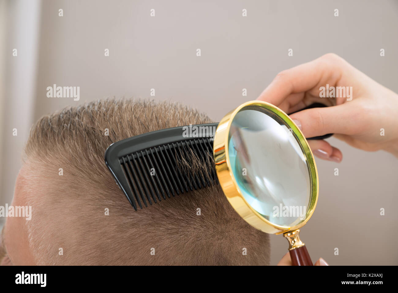 Close-up Dermatologist Looking At Patient's Hair Through Magnifying Glass Stock Photo