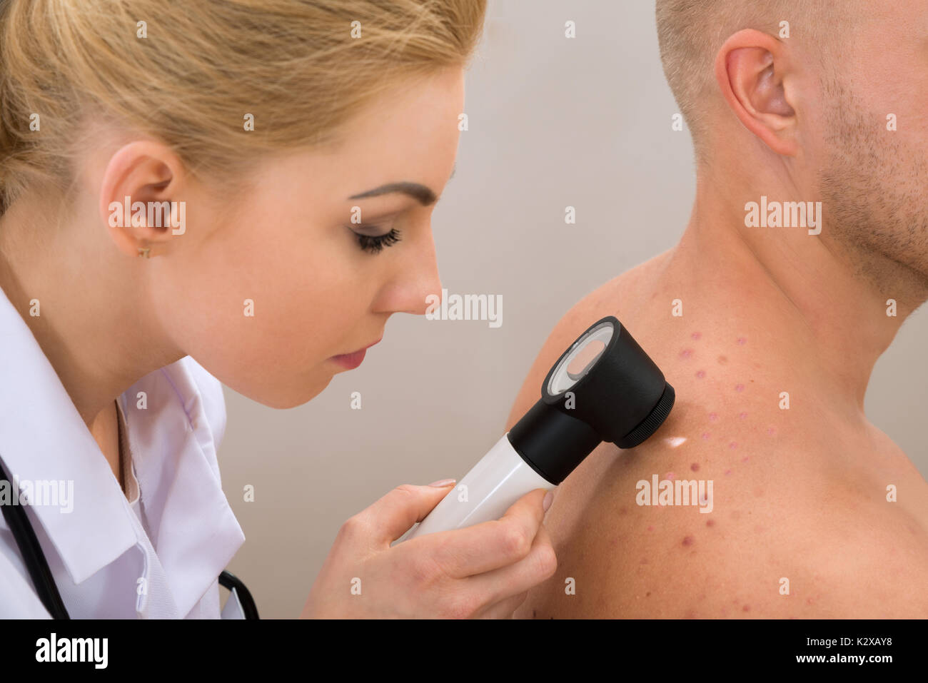 Female Doctor Examining Pigmented Skin With Dermatoscope Stock Photo