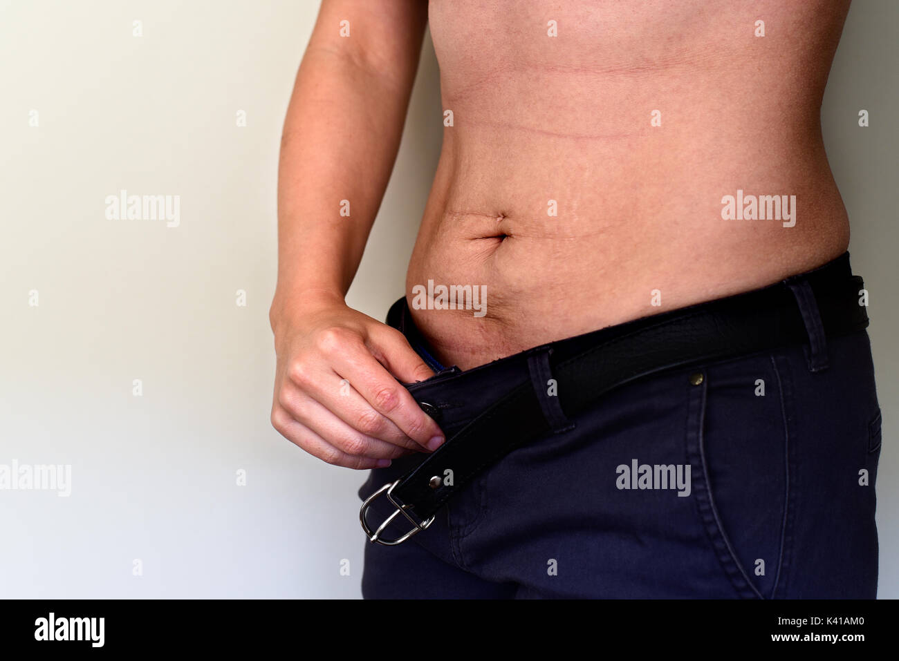 Woman holds belly with stretch marks and scars after pregnancy,weight loss and piercing Stock Photo