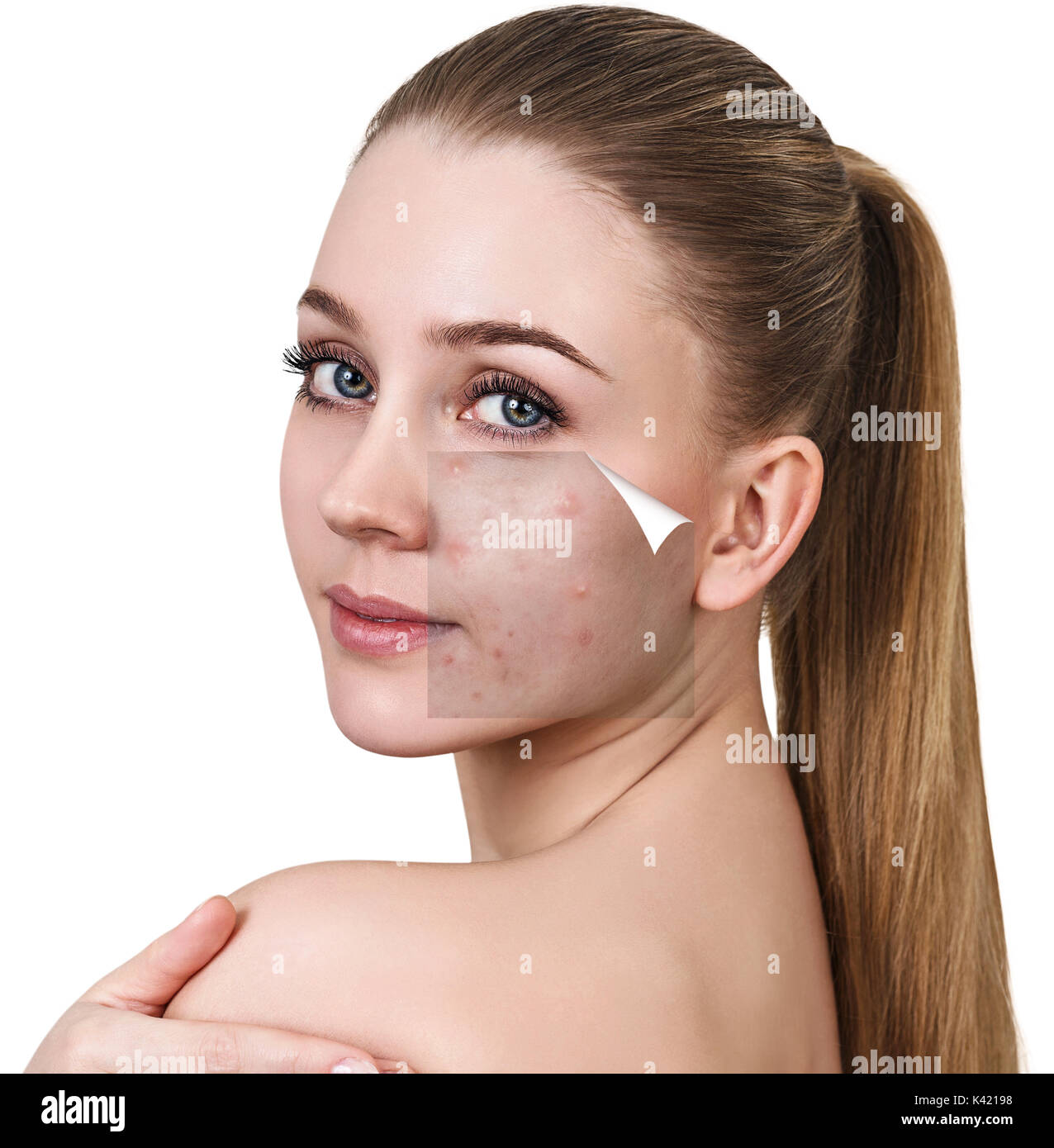 Woman face before and after treatment skin. Stock Photo