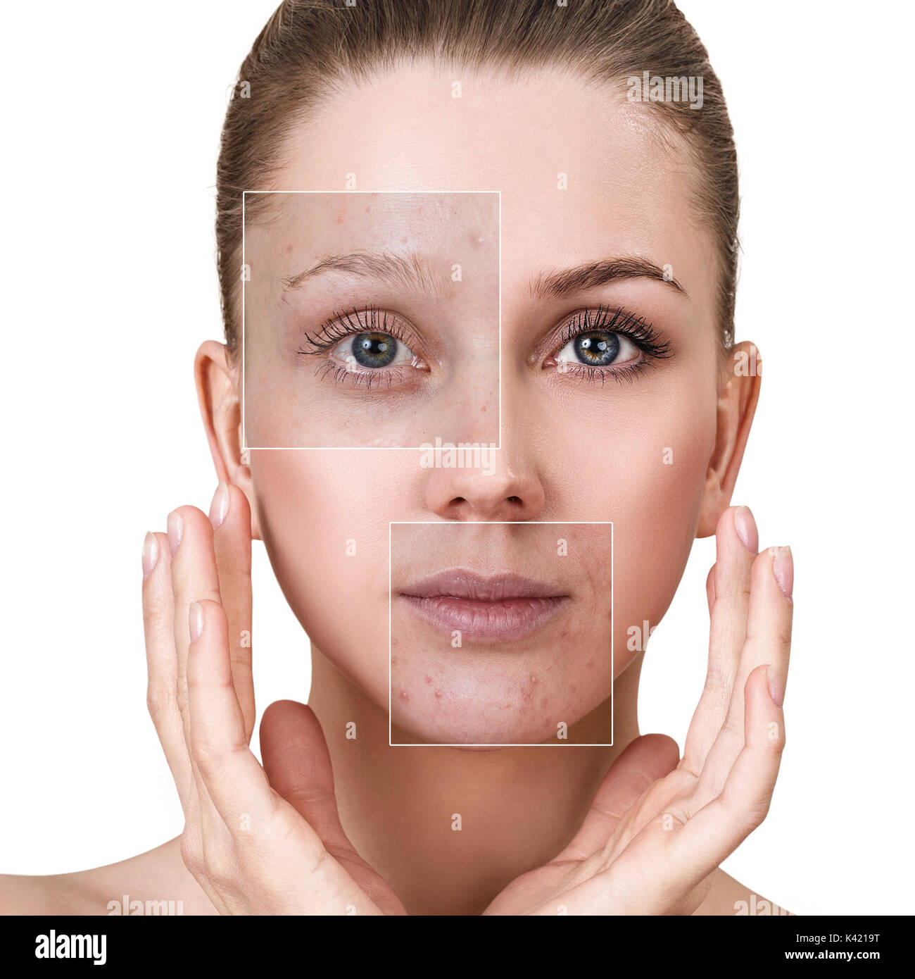 Woman's face before and after treatment Stock Photo Alamy