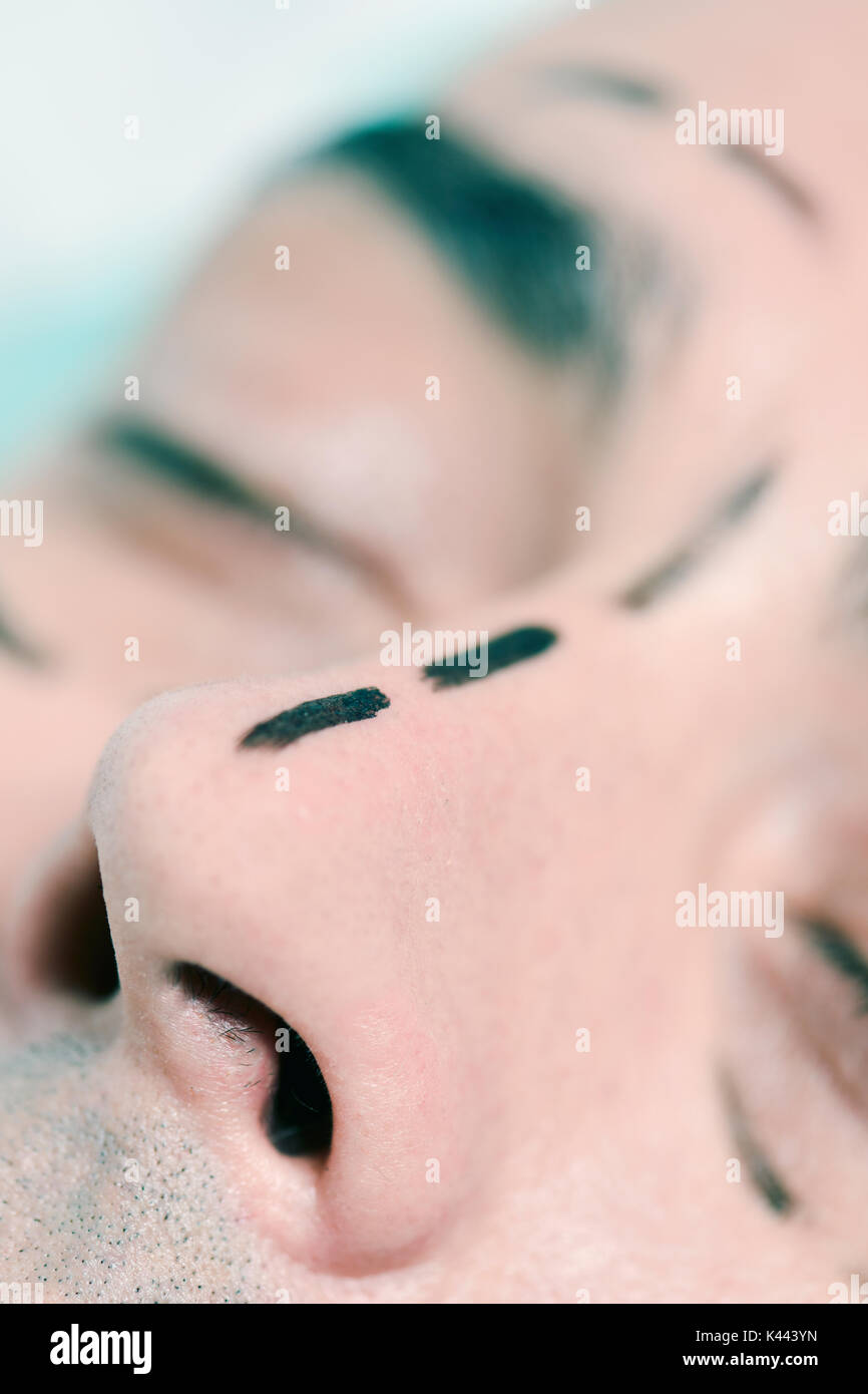 closeup of the head of a young caucasian man who is about to have a plastic surgery in his face, with surgery lines marked in his nose and around his  Stock Photo