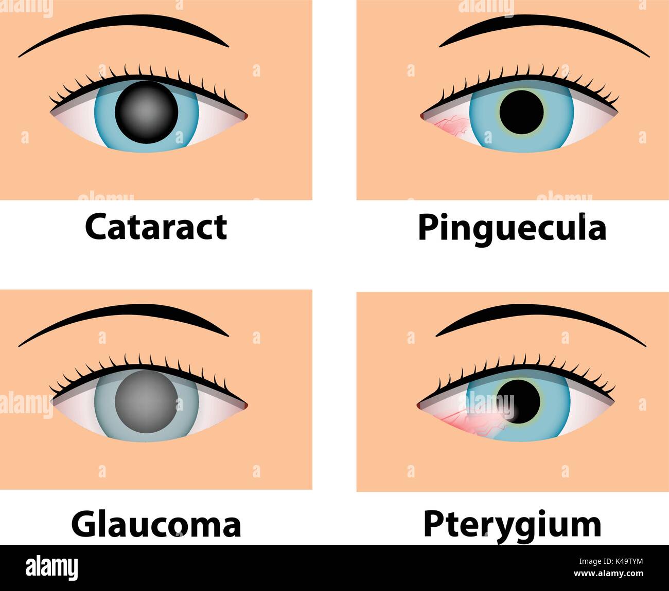 Cataract, Pinguecula, and Pterygium, vector eye care Stock