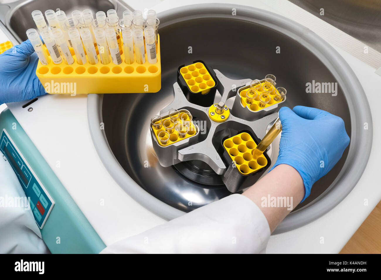 Centrifugation of urine, microscopic assessment of urine sediment