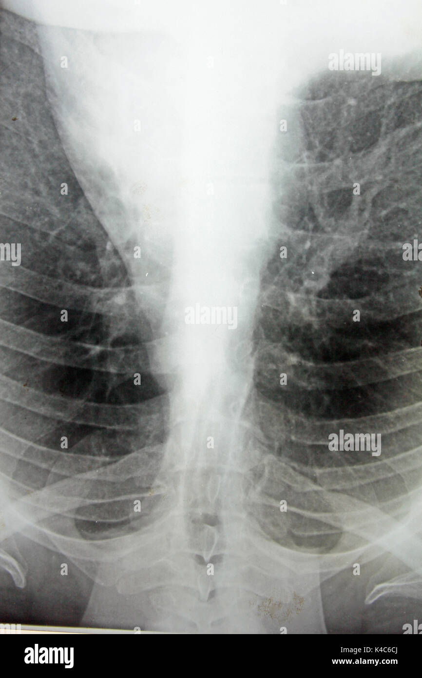 Diseased Lung X Ray Hi-res Stock Photography And Images - Alamy