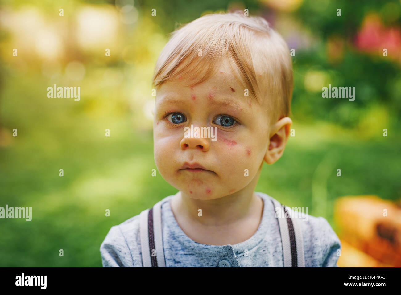 One year unhappy child with allergy and insect bites on face. Portrait in summer garden. Stock Photo