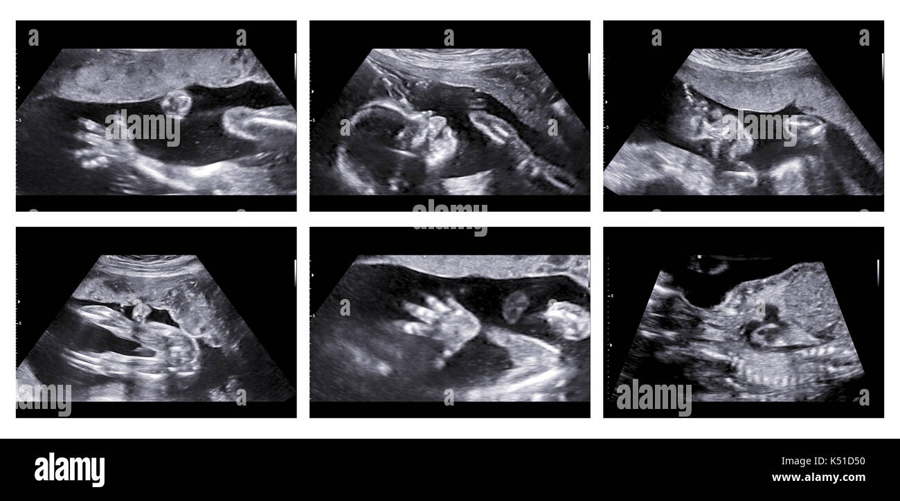 Collage of medical images of ultrasound anomaly scan on a female fetus 20 weeks into the pregnancy, showing child's hand, head, feet, legs, spine and  Stock Photo