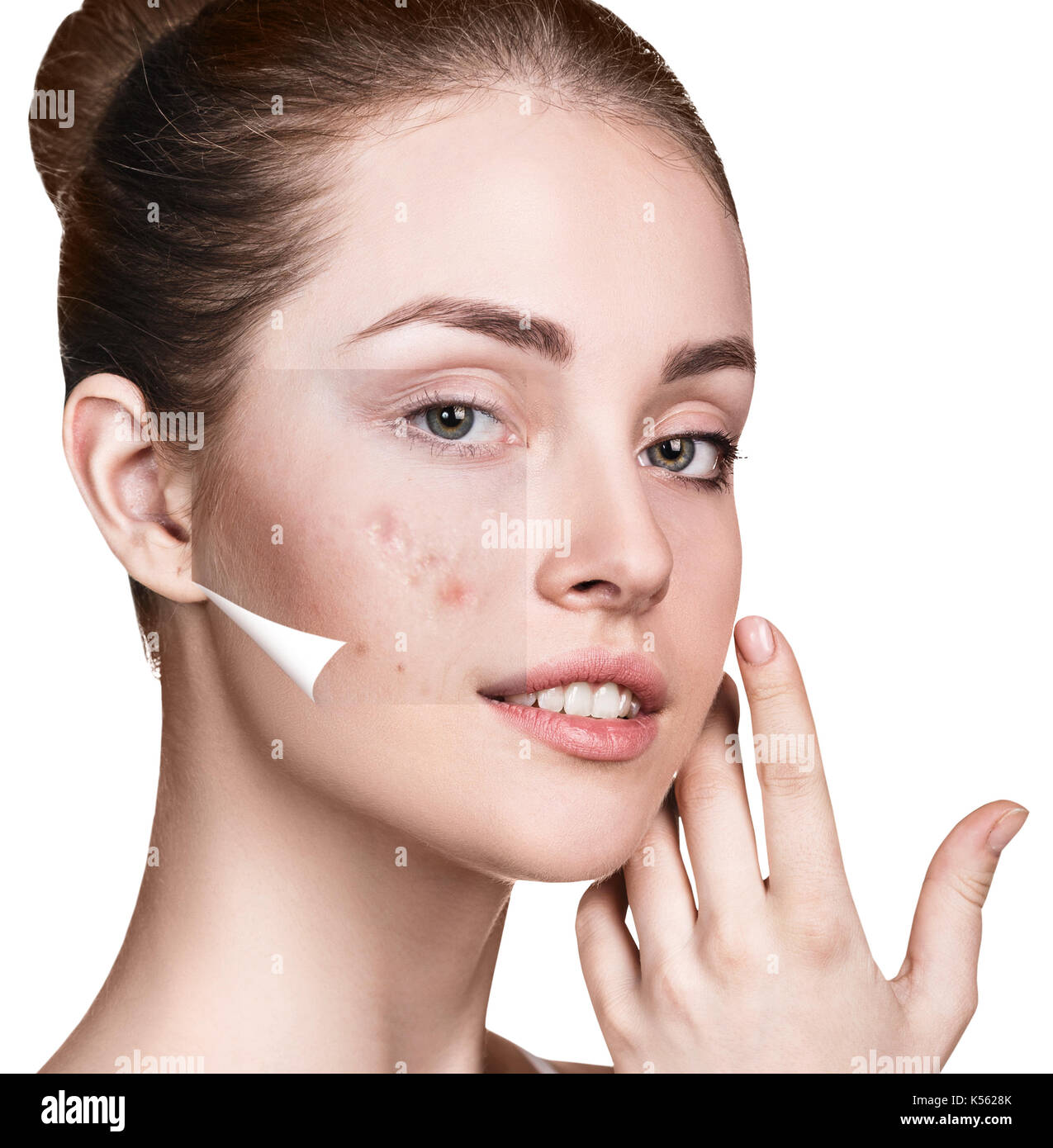 Layer with acne unstick from good healthy skin of young woman. Stock Photo