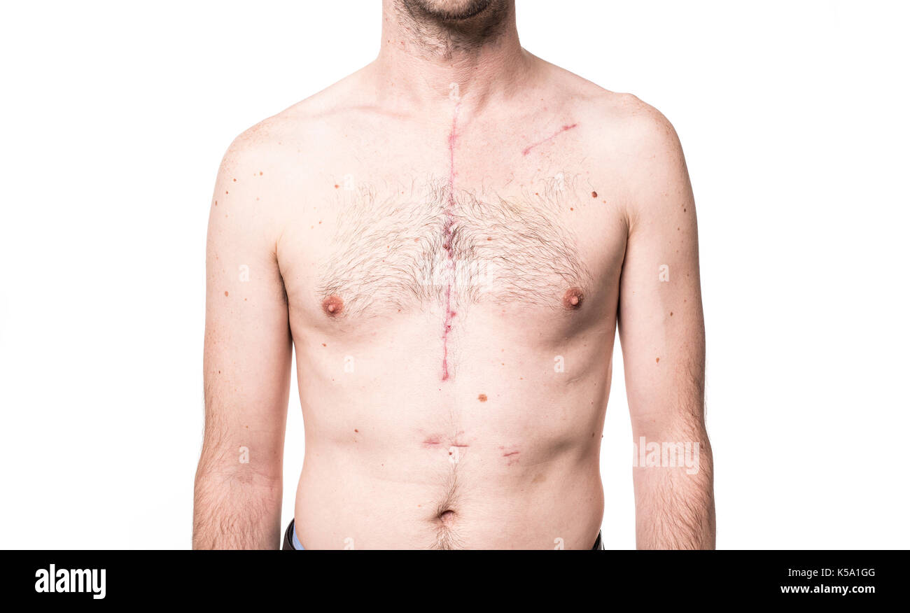 Some Scar from open heart surgery in studio Stock Photo