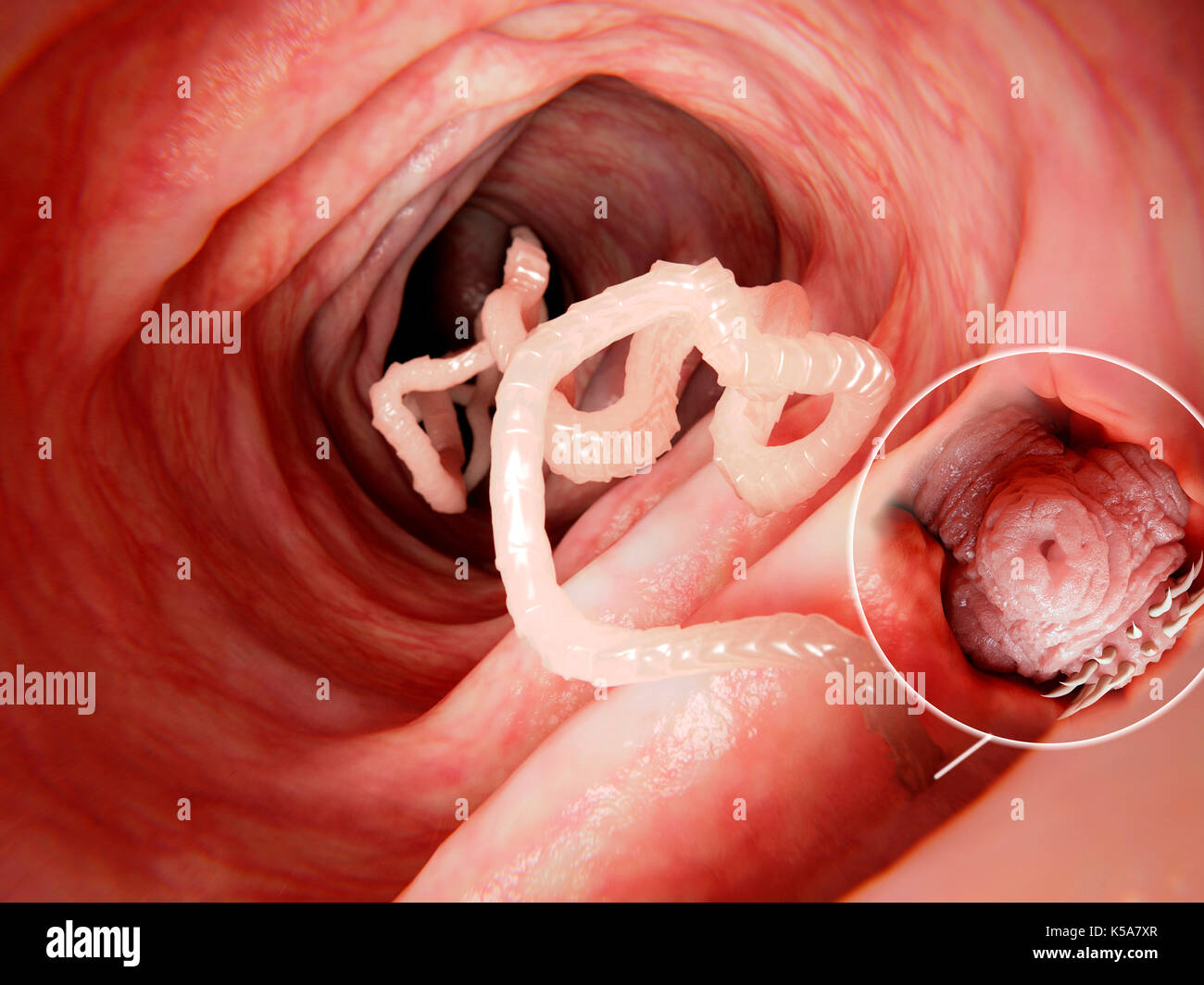 Illustration of a tapeworm in a human intestine. Tapeworms (Taenia sp.) are parasites that inhabit the human gut. They anchor themselves to the inside of the intestine and absorb nutrients through their body wall. Tapeworms may grow to several metres in length, but infestation does not necessarily cause symptoms. Stock Photo