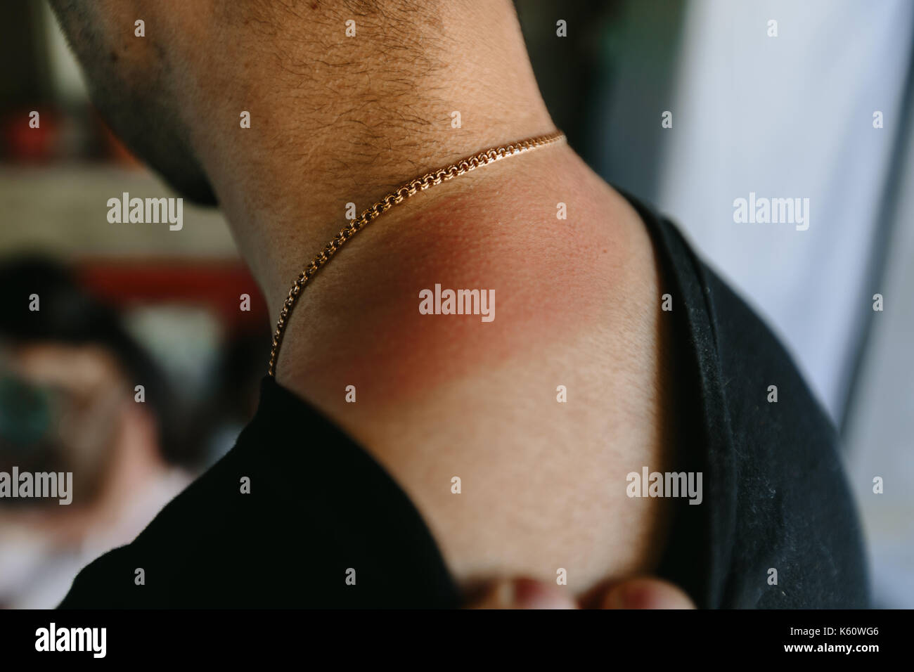 Trail of sunburn on the neck of a man Stock Photo