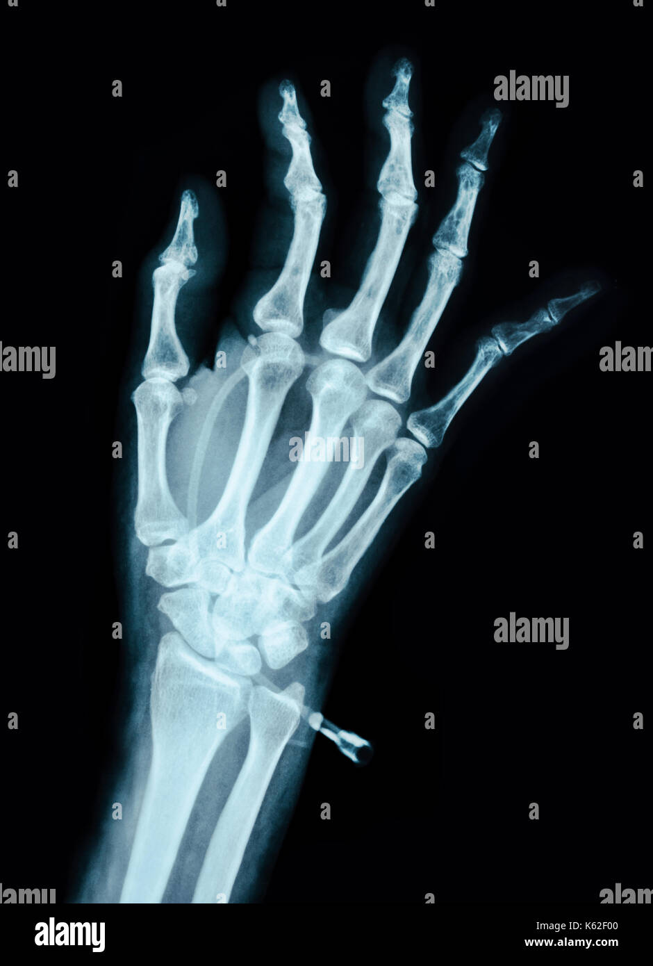 Human Left hand on device x ray Medical Image Stock Photo Alamy