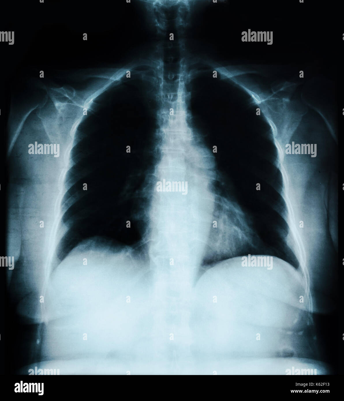 Tuberculosis lung x ray hi-res stock photography and images - Alamy