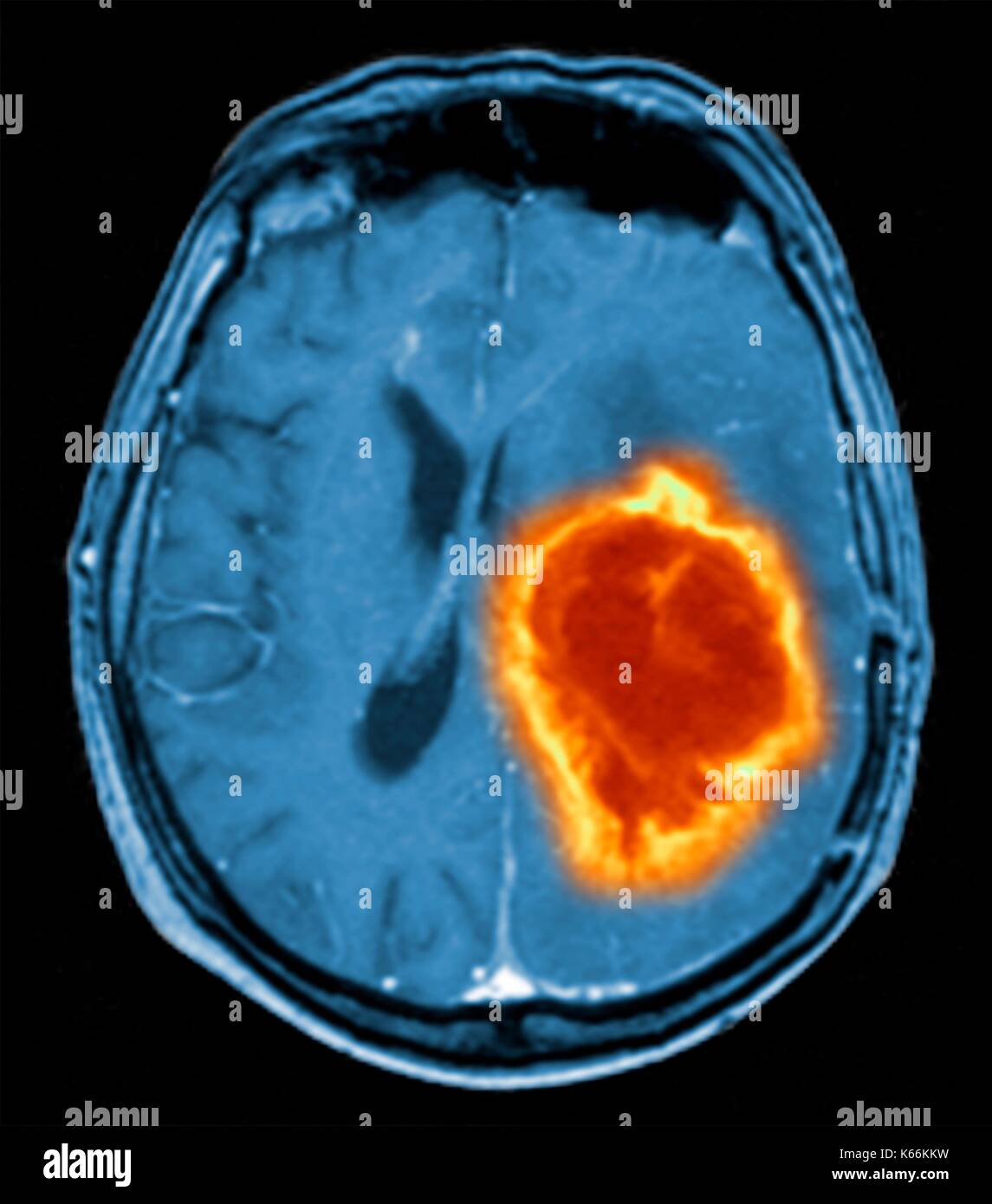 Brain tumour. Coloured Magnetic Resonance Imaging (MRI) scan of an axial section through the brain showing a metastatic tumour. At bottom left is the tumour (red-yellow) This tumour occurs within one cerebral hemisphere; the other hemisphere is at right. The eyeballs - not visible -are at top. Metastatic cancer is a secondary disease spread from cancer elsewhere in the body. Metastatic brain tumours are malignant. Typically they cause brain compression and nerve damage Stock Photo