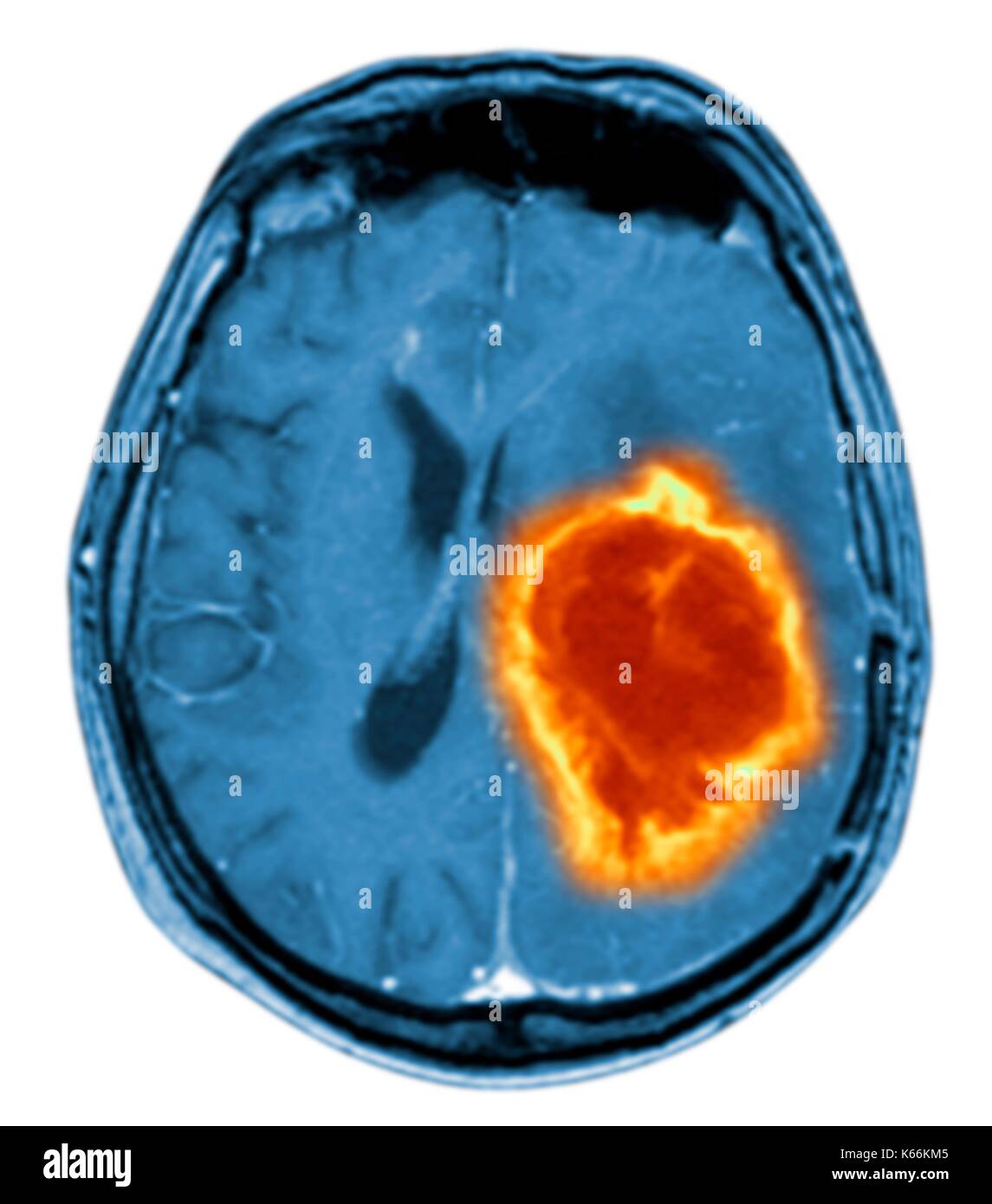 Brain tumour. Coloured Magnetic Resonance Imaging (MRI) scan of an axial section through the brain showing a metastatic tumour. At bottom left is the tumour (red-yellow) This tumour occurs within one cerebral hemisphere; the other hemisphere is at right. The eyeballs - not visible -are at top. Metastatic cancer is a secondary disease spread from cancer elsewhere in the body. Metastatic brain tumours are malignant. Typically they cause brain compression and nerve damage Stock Photo