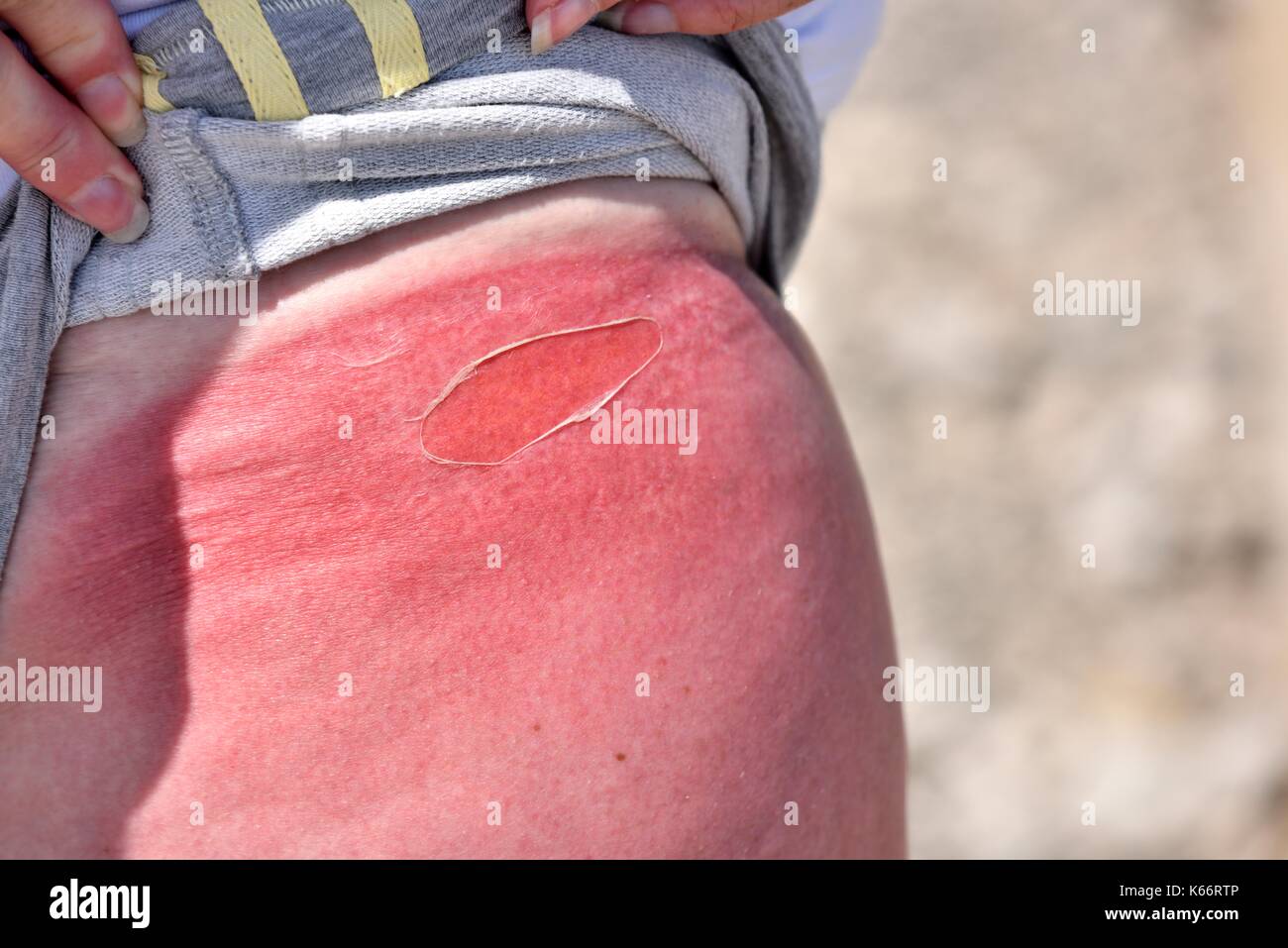 Sunburn at the top of a womans leg Stock Photo